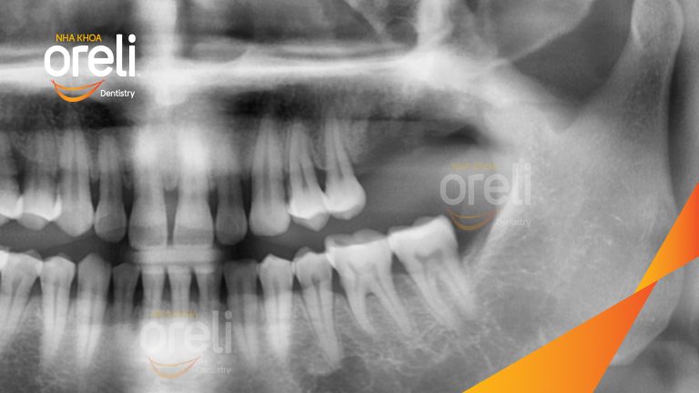 Ca Cấy Ghép Implant Hàm Trên– Case thực tế tại Oreli