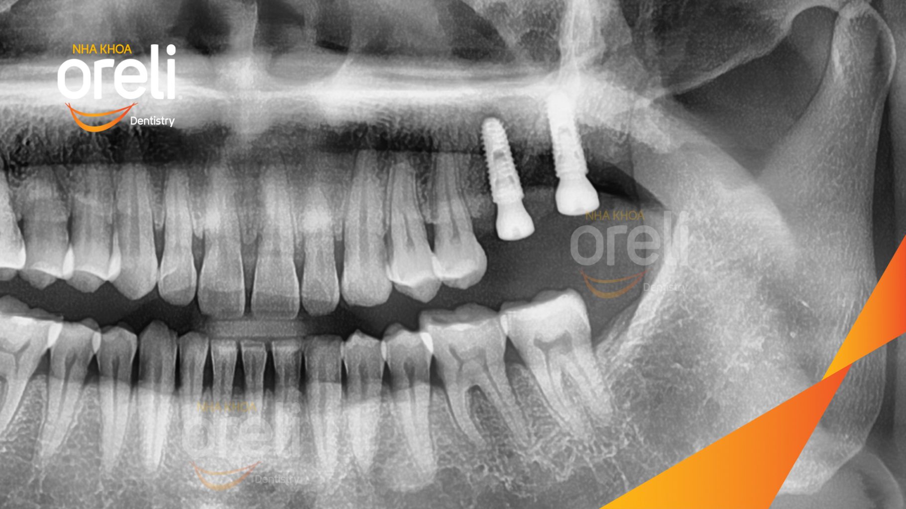 Mất răng hàm trên trước khi điều trị tại Oreli