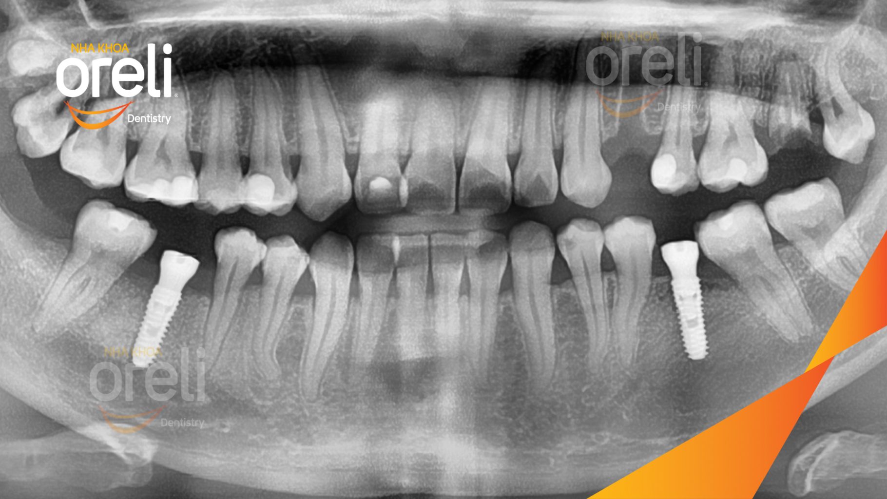 Mất răng hàm dưới trước khi điều trị tại Oreli