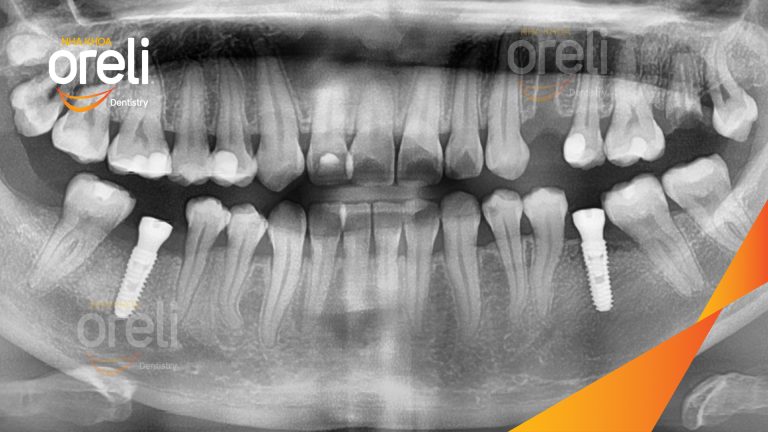 Ca Cấy Ghép Implant Hàm Dưới – Case thực tế tại Oreli