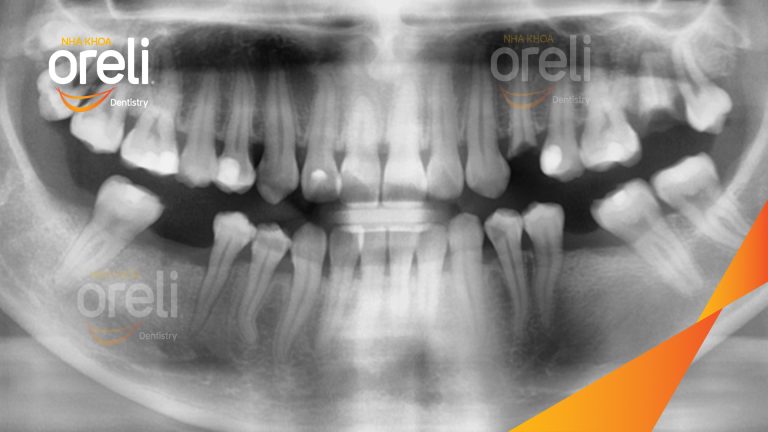Ca Cấy Ghép Implant Hàm Dưới – Case thực tế tại Oreli