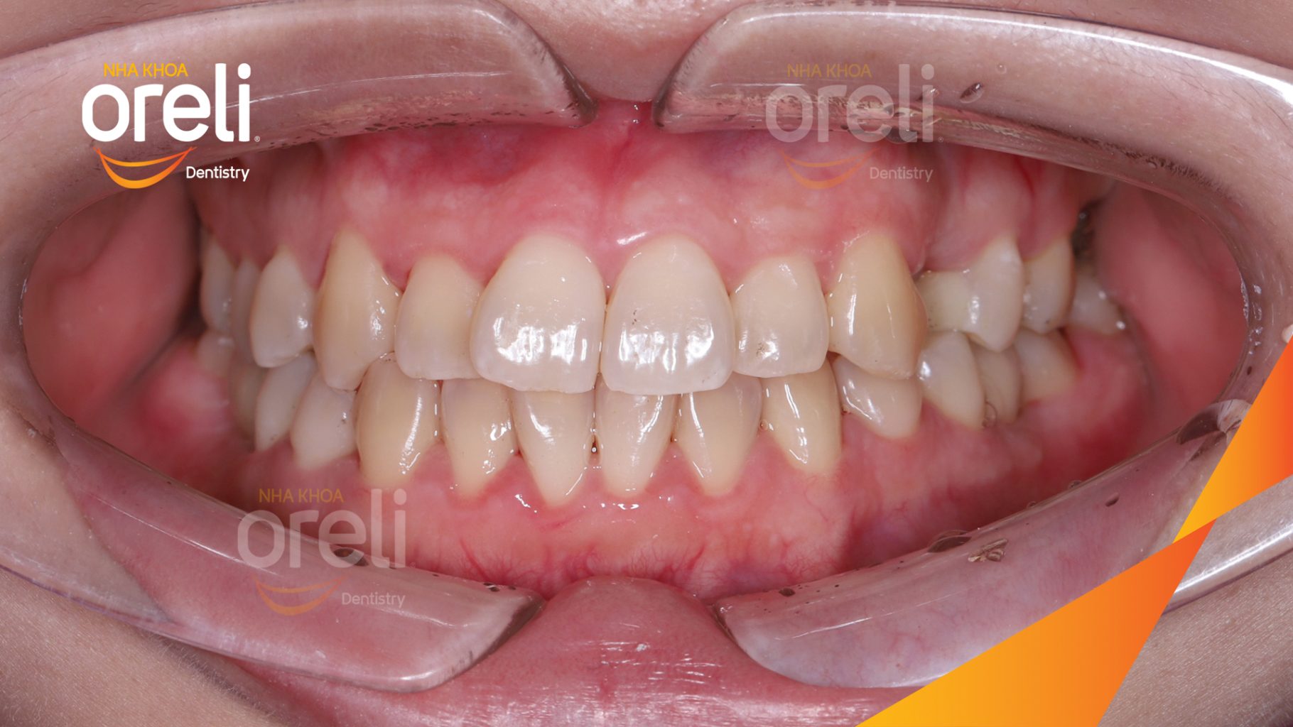 Quá trình Cấy ghép trụ Implant chính hãng vào vùng mất răng trong 3 tháng tại Oreli