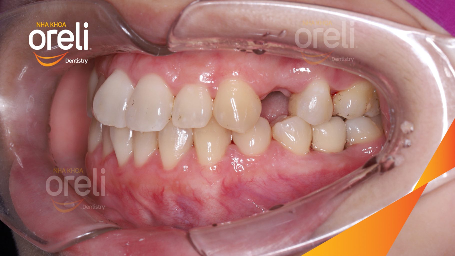 Kết quả sau 3 tháng: Hoàn thành đặt trụ Implant đúng vị trí mất răng tại Oreli
