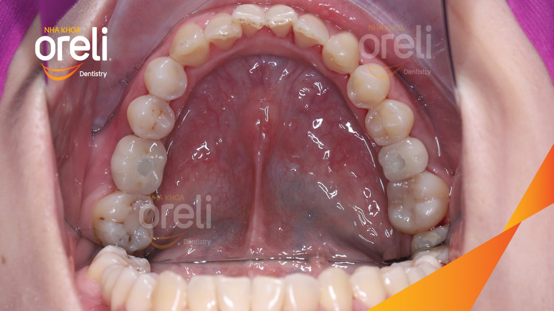 Thực hiện Cấy ghép trụ Implant chính hãng vào vùng mất răng kéo dài 3 tháng tại Oreli