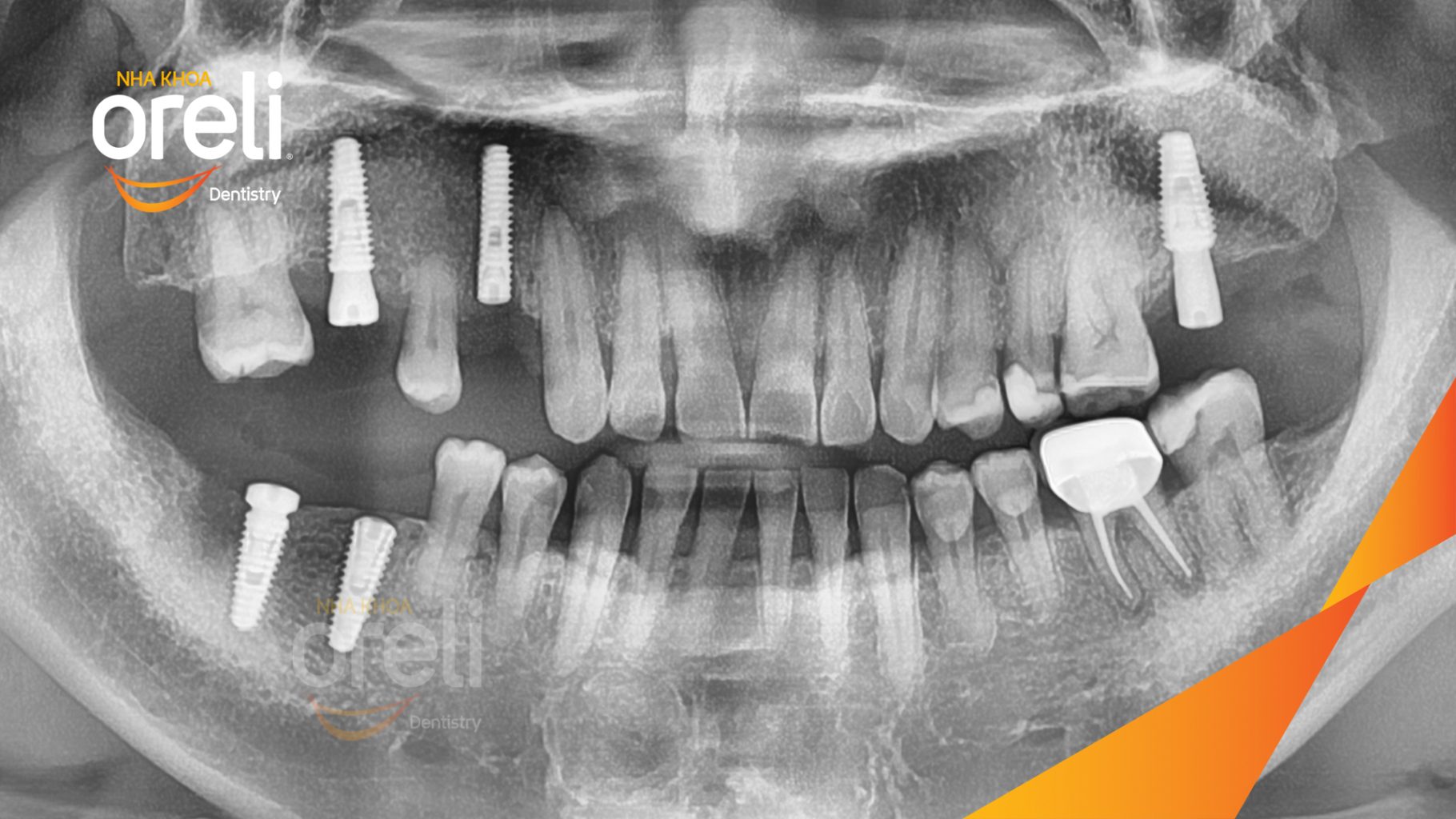 Mất răng hàm trên và dưới trước khi điều trị tại Oreli