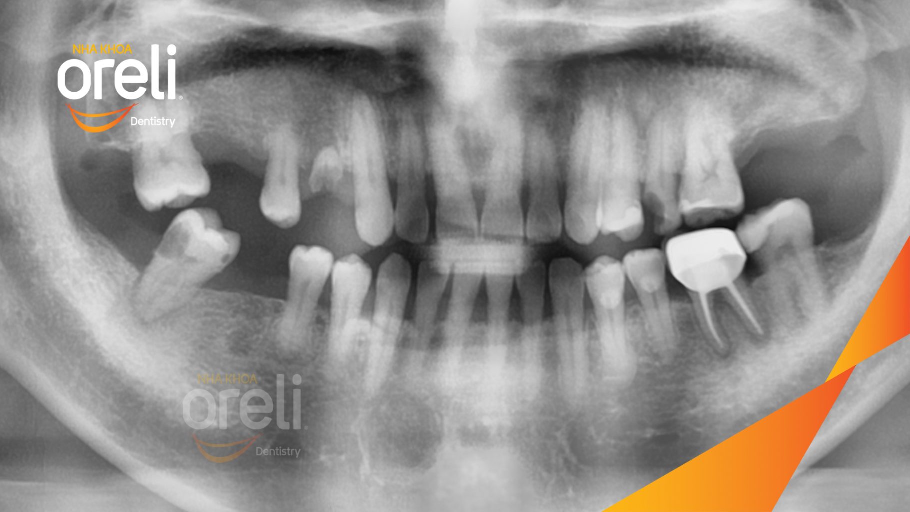 Trước điều trị: Mất răng hàm trên và dưới tại Oreli
