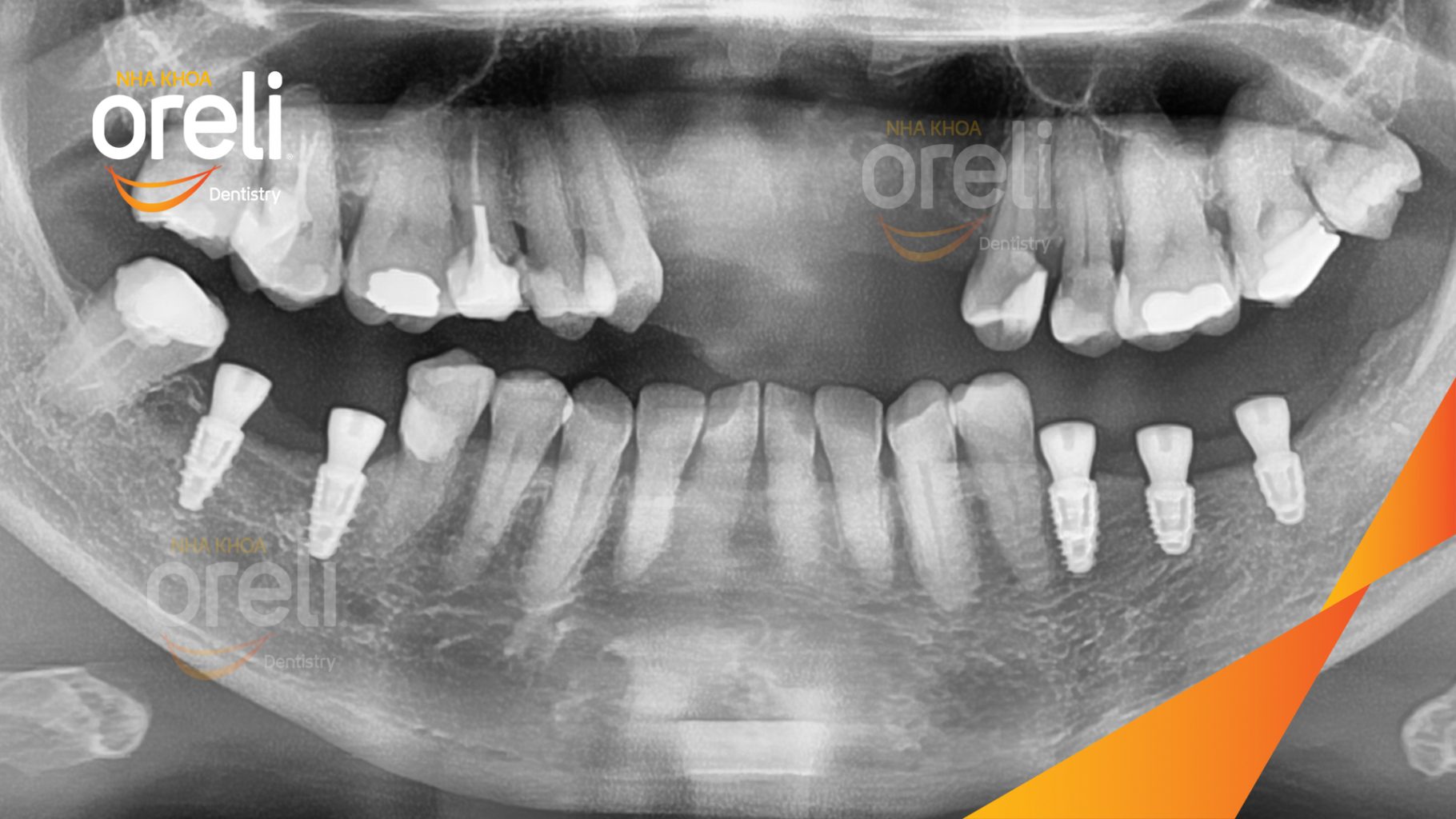 Mất răng hàm dưới trước khi điều trị tại Oreli