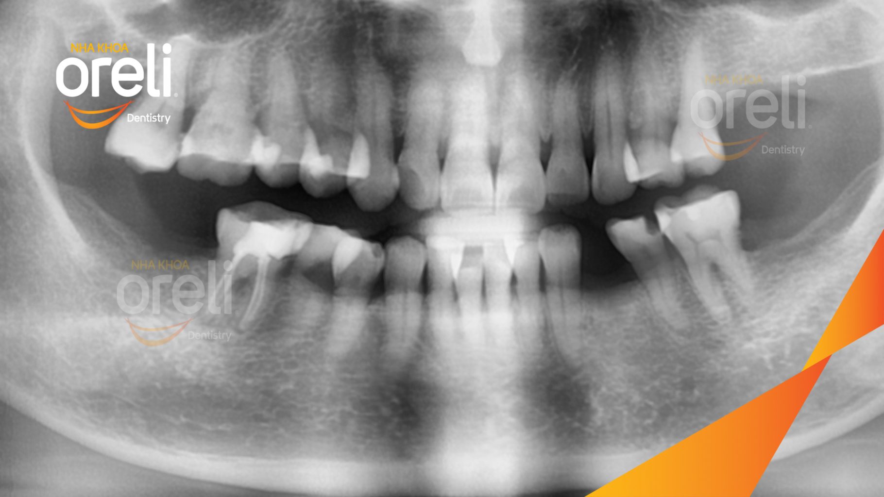 Trước điều trị: Mất răng hàm dưới tại Oreli