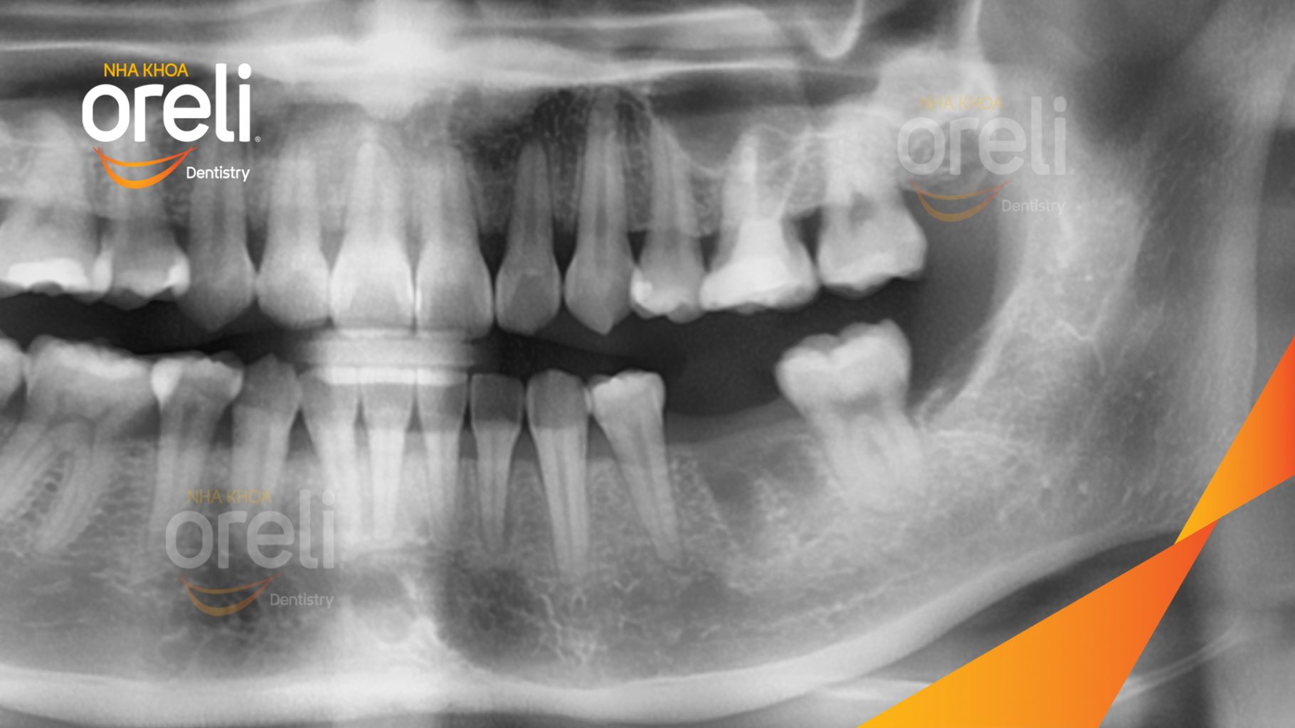 Trước điều trị: Mất răng hàm dưới tại Oreli