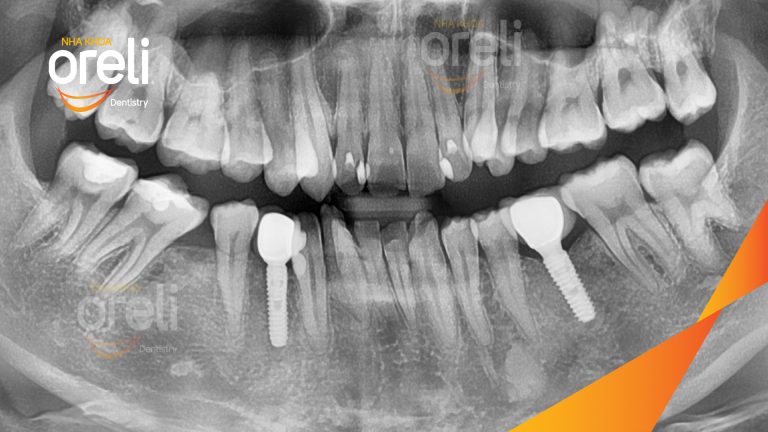Ca Cấy Ghép Implant Phục Hồi Răng Tại Nha Khoa Oreli