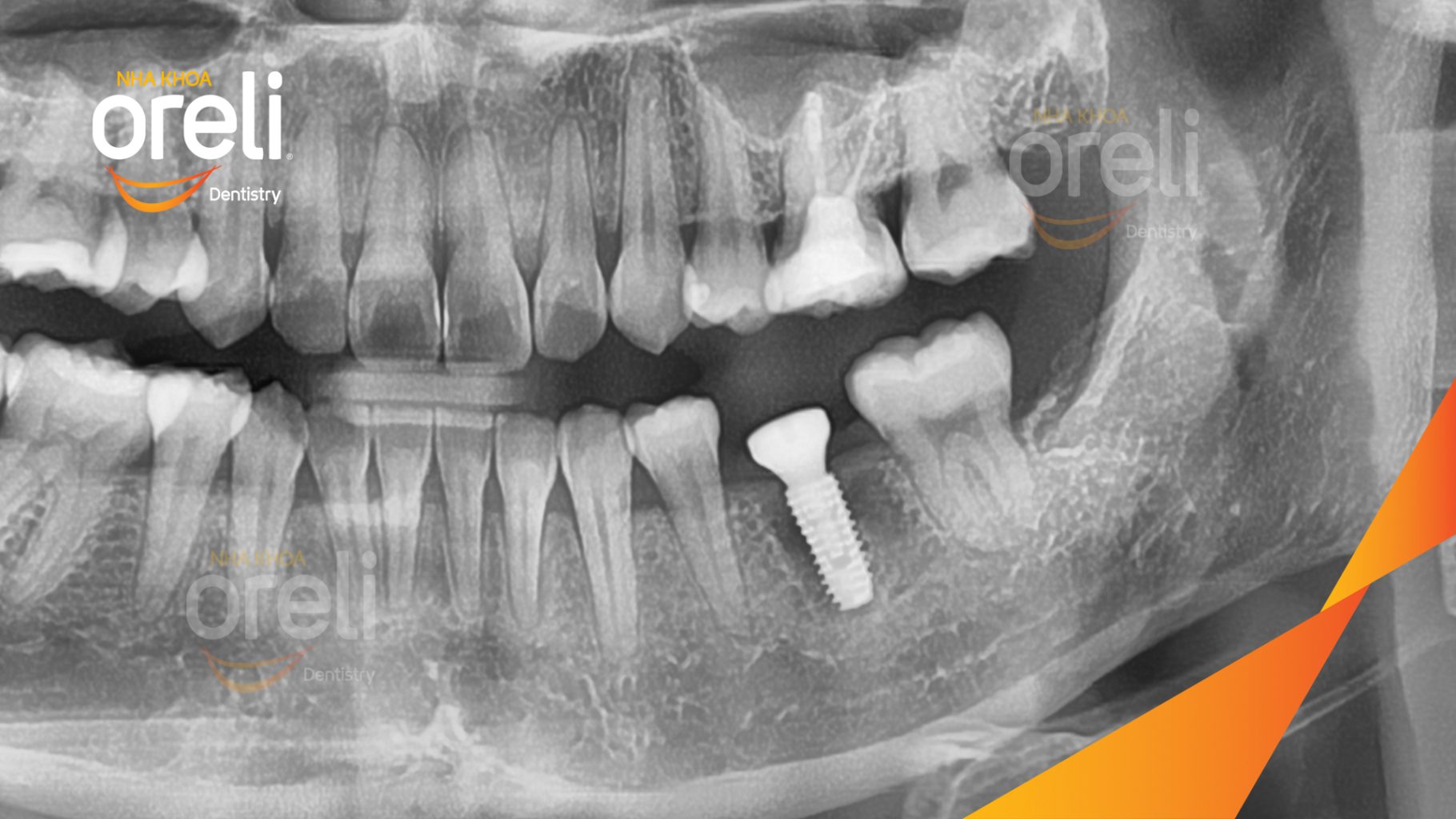 Mất răng hàm dưới trước khi điều trị tại Oreli