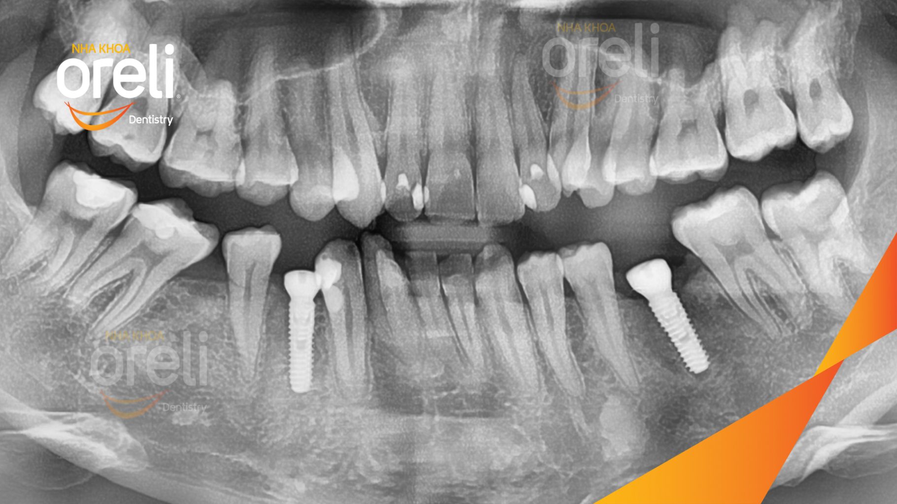 Mất răng hàm dưới trước khi điều trị tại Oreli