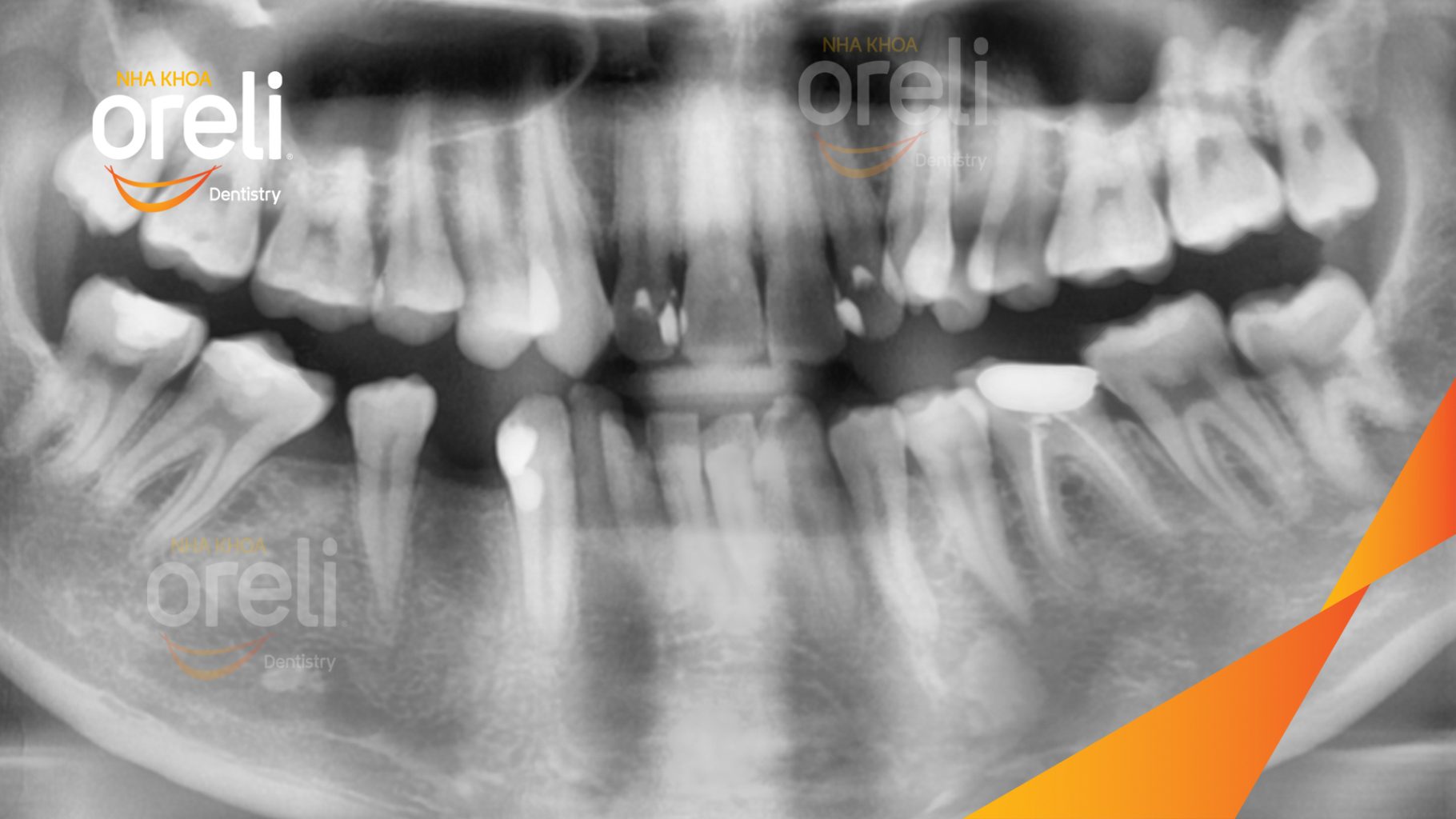 Trước điều trị: Mất răng hàm dưới tại Oreli
