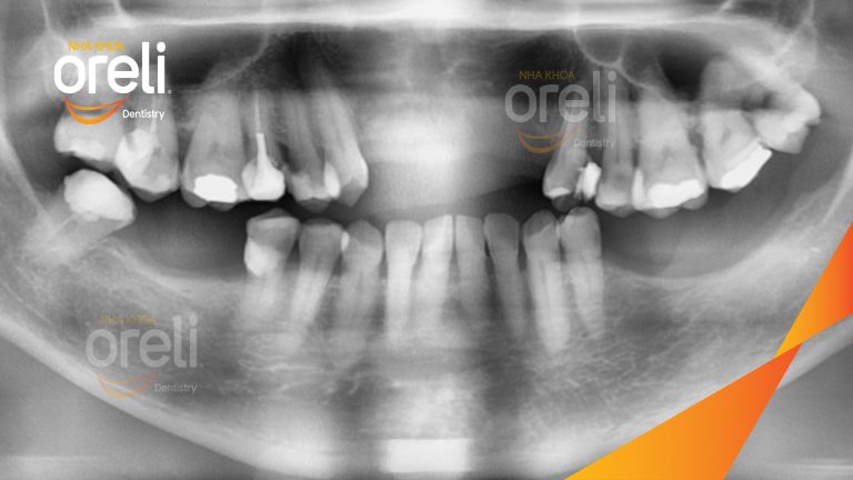 Ca Cấy Ghép Implant Hàm Dưới – Case thực tế tại Oreli