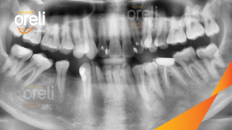 Ca Cấy Ghép Implant Phục Hồi Răng Tại Nha Khoa Oreli