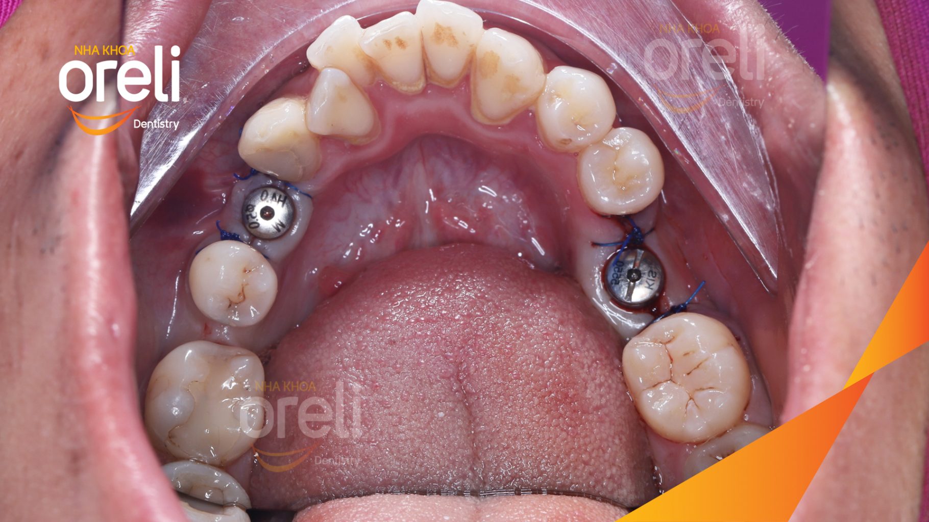 Thực hiện Cấy ghép trụ Implant chính hãng vào vùng mất răng kéo dài 3 tháng tại Oreli