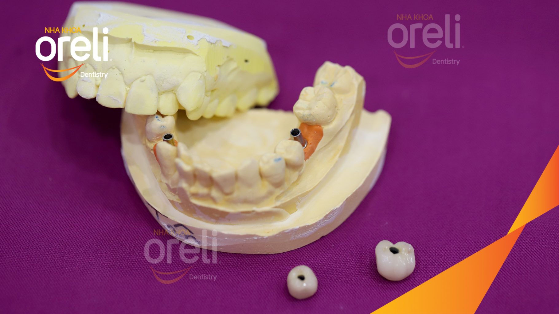 Kết quả đạt được sau 3 tháng - Phục hồi răng mất - ăn nhai chắc chắn và cười nói tự tin tại Oreli
