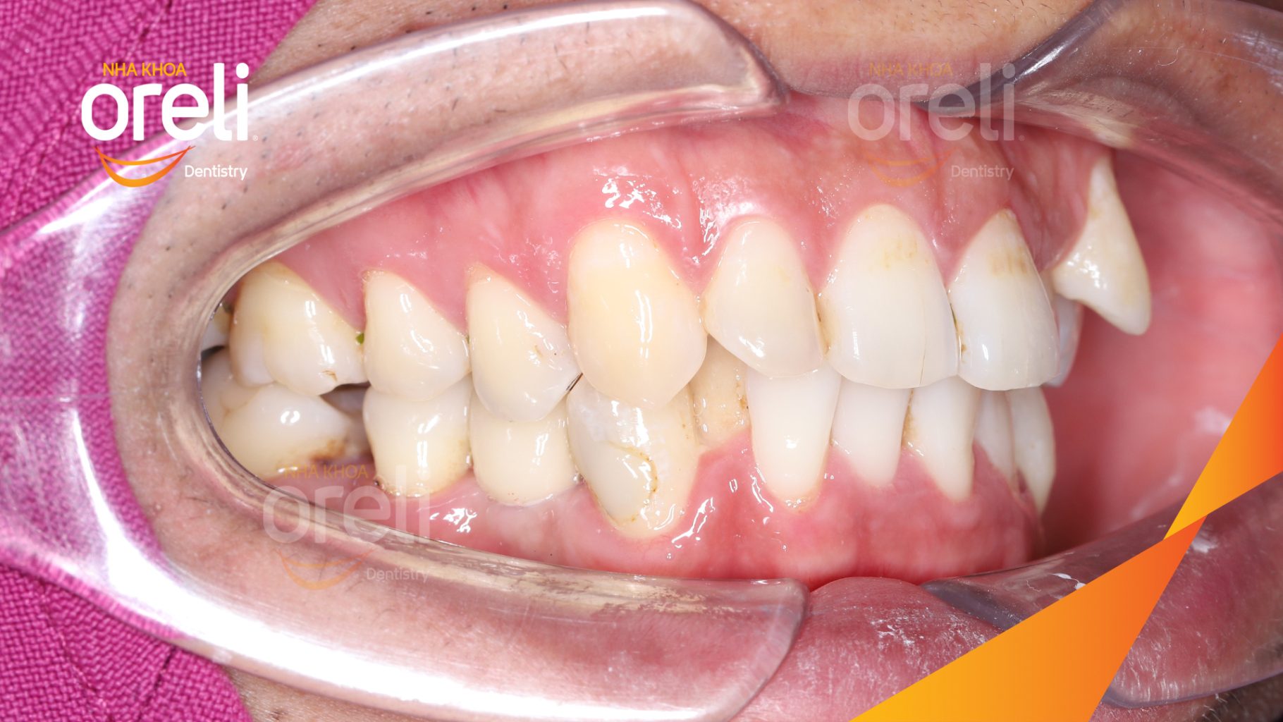 Kết quả sau 3 tháng: Phục hồi răng mất - ăn nhai chắc chắn và cười nói tự tin tại Oreli