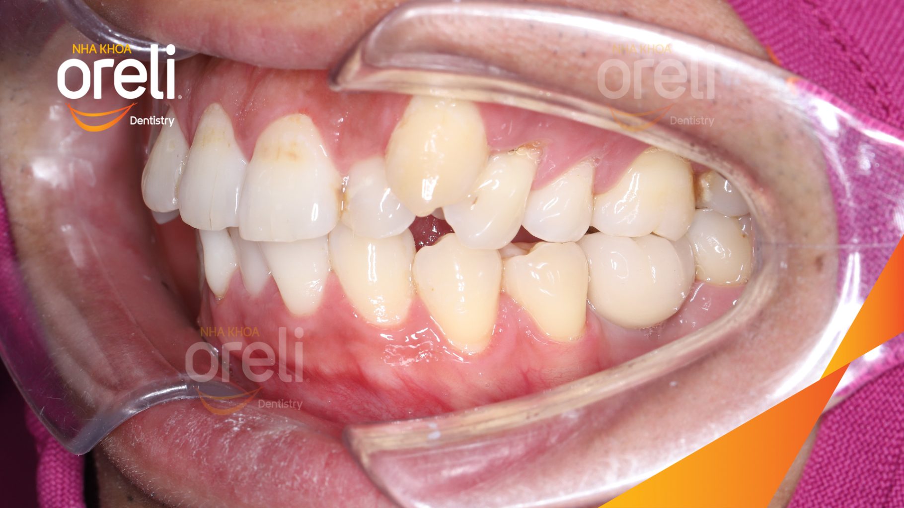 Kết quả đạt được sau 3 tháng - Phục hồi răng mất - ăn nhai chắc chắn và cười nói tự tin tại Oreli
