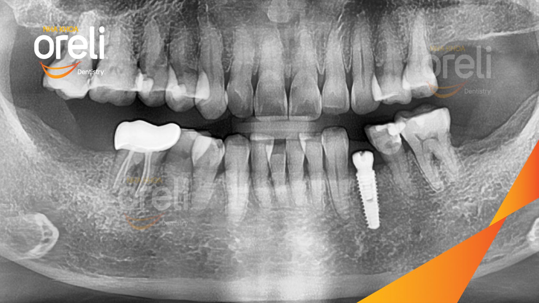 Mất răng hàm dưới trước khi điều trị tại Oreli