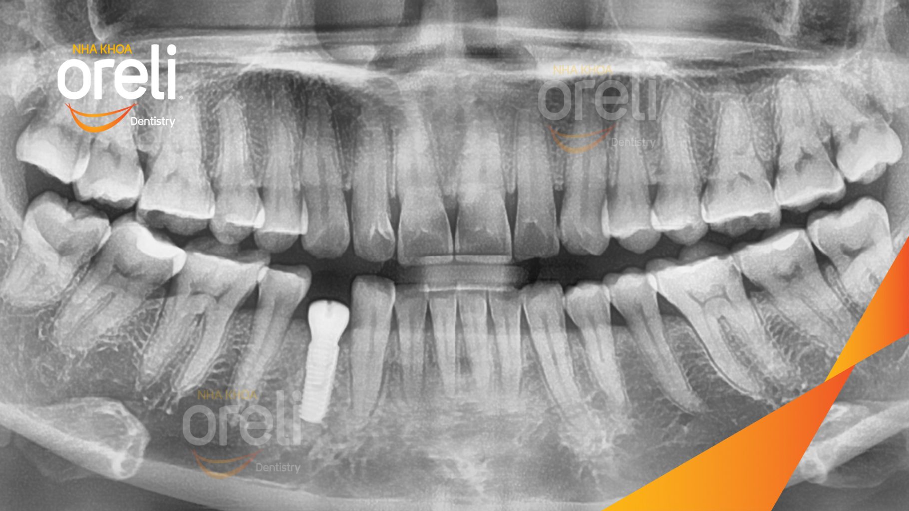 Mất răng hàm dưới trước khi điều trị tại Oreli