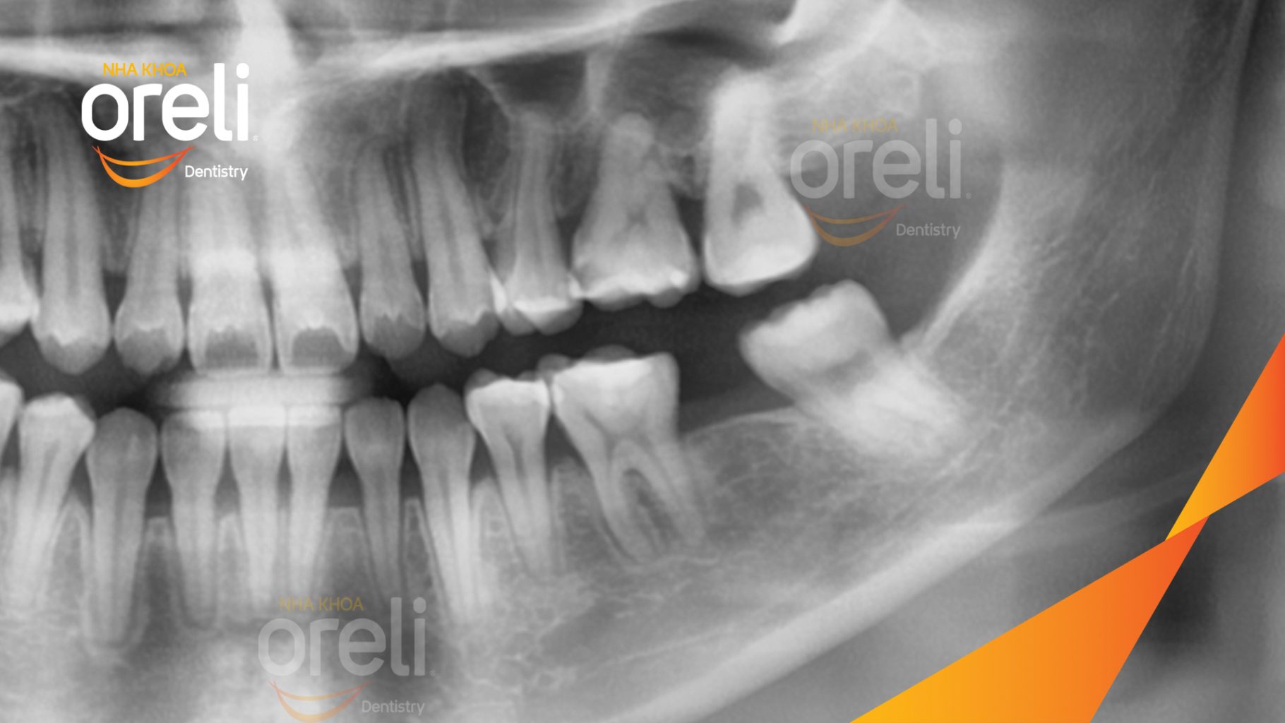 Trước điều trị: Mất răng hàm dưới tại Oreli