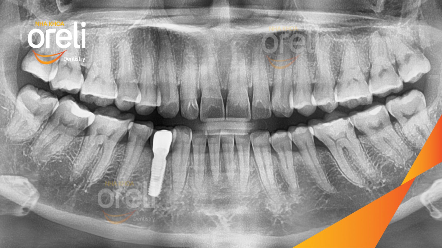 Thực hiện Cấy ghép trụ Implant chính hãng vào vùng mất răng kéo dài 3 tháng tại Oreli