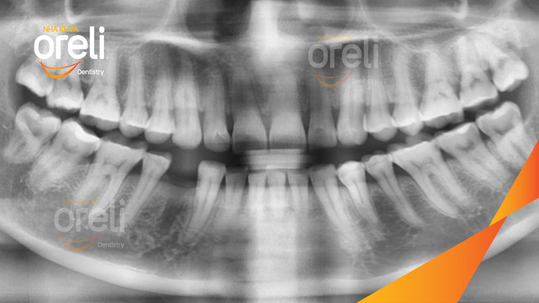 Trước điều trị: Mất răng hàm dưới tại Oreli