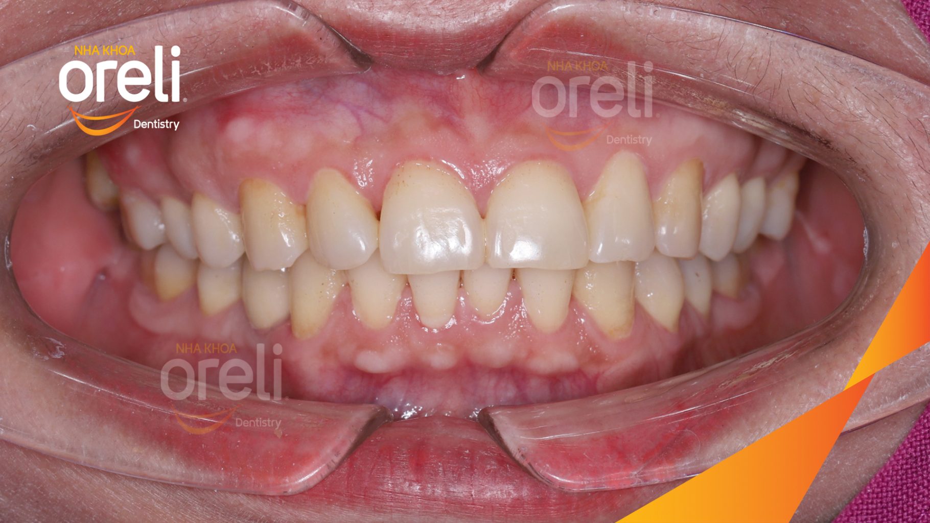 Kết quả sau 3 tháng: Hoàn thành đặt trụ Implant đúng vị trí mất răng tại Oreli