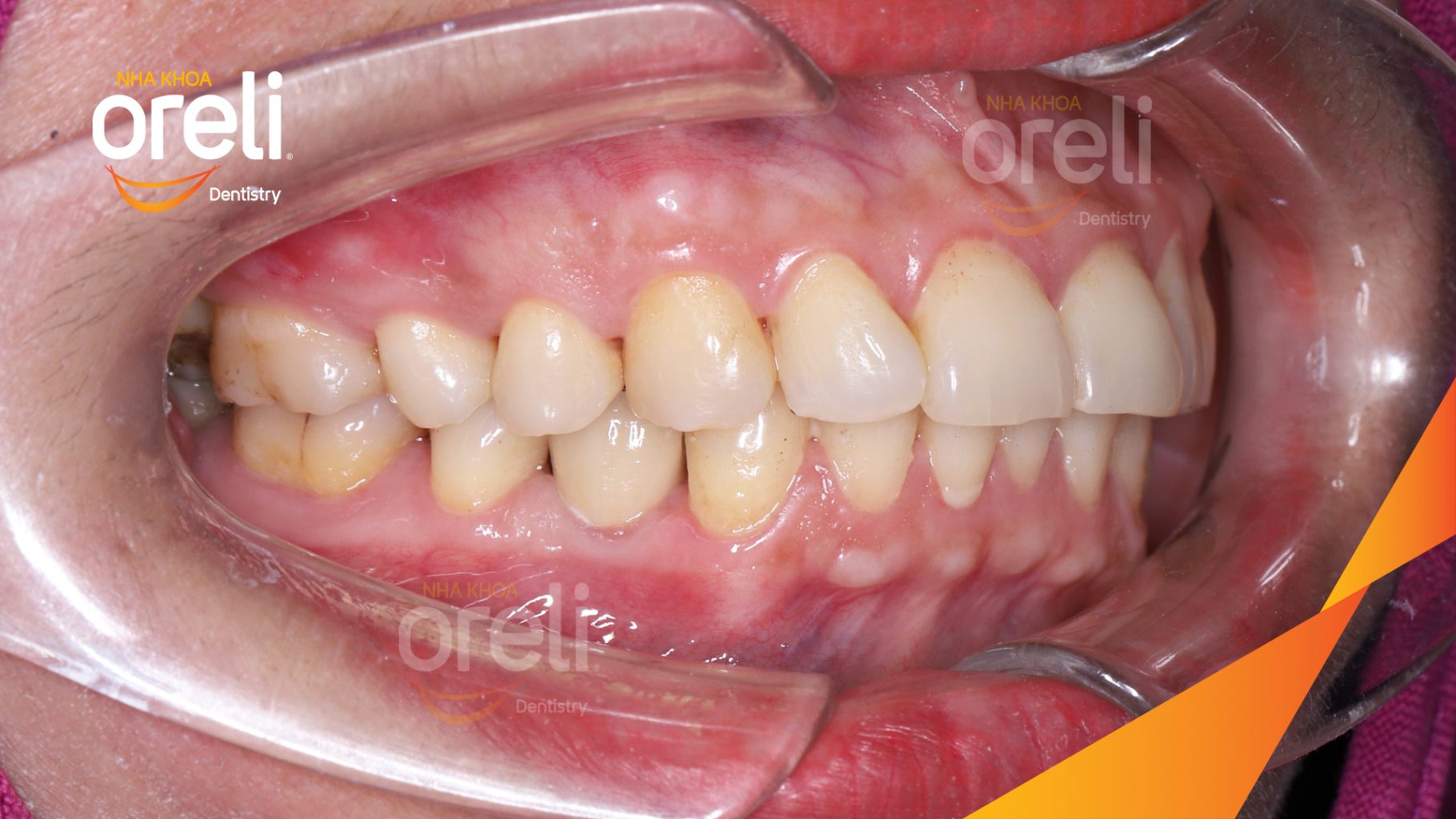 Kết quả đạt được sau 3 tháng - Hoàn thành đặt trụ Implant đúng vị trí mất răng tại Oreli