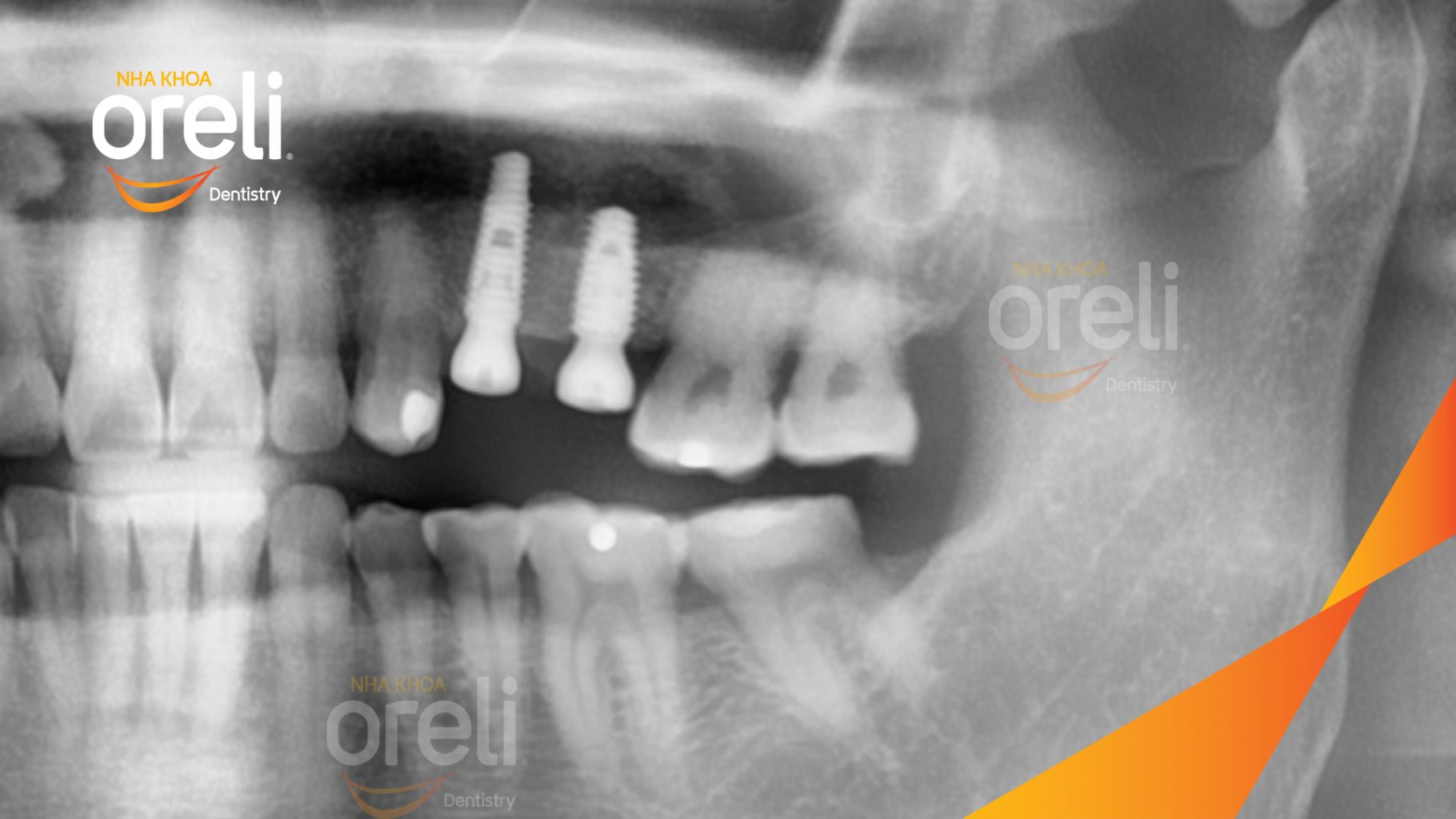 Mất răng hàm trên trước khi điều trị tại Oreli