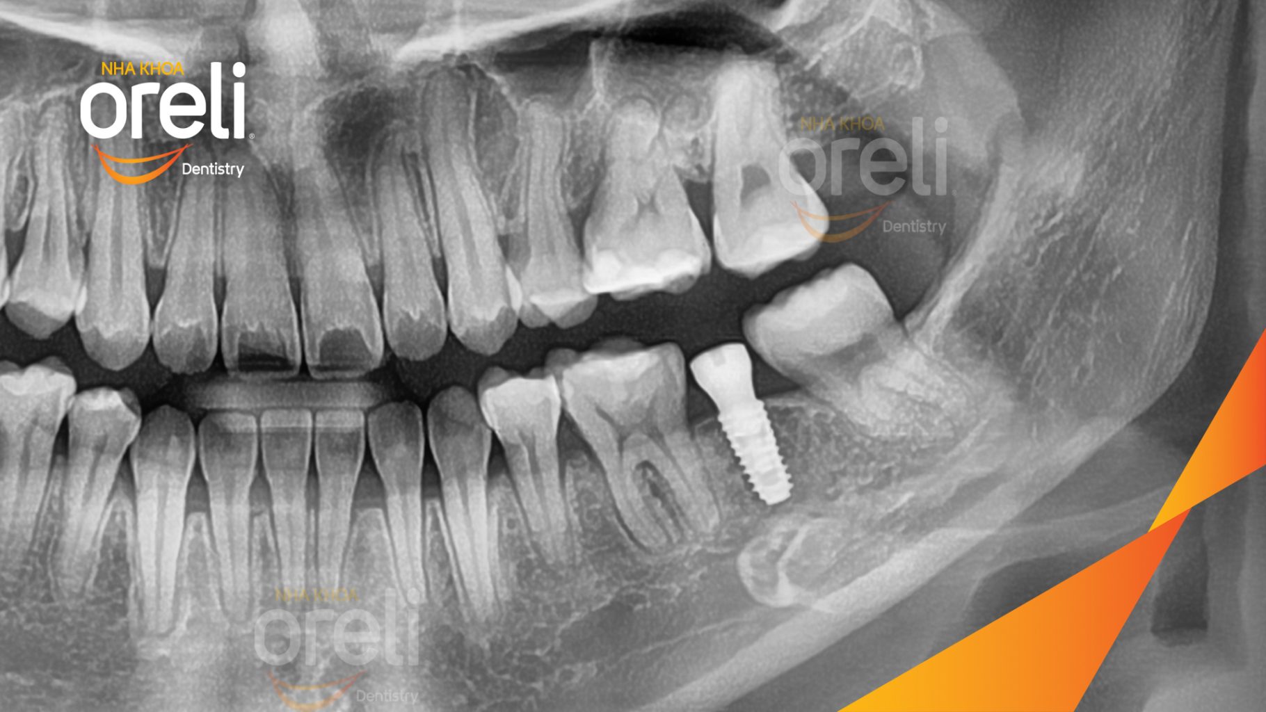 Mất răng hàm dưới trước khi điều trị tại Oreli