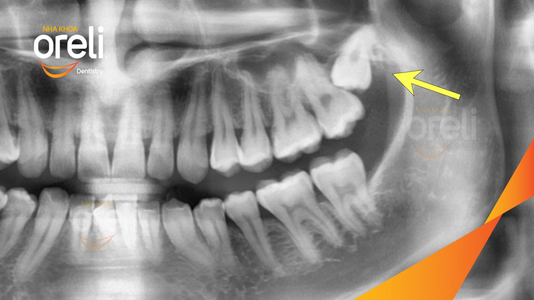 Trước điều trị: Răng khôn hàm trên mọc lệch tại Oreli