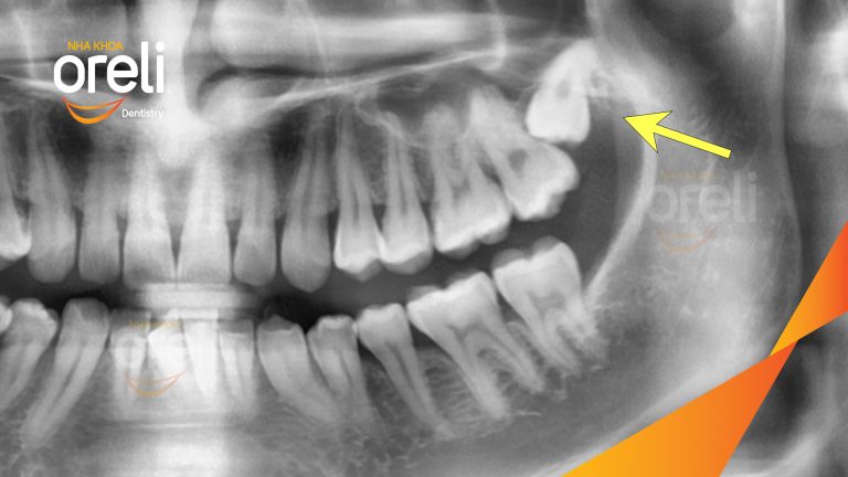 Nhổ răng khôn hàm trên– Case thực tế tại Oreli Buôn Ma Thuột