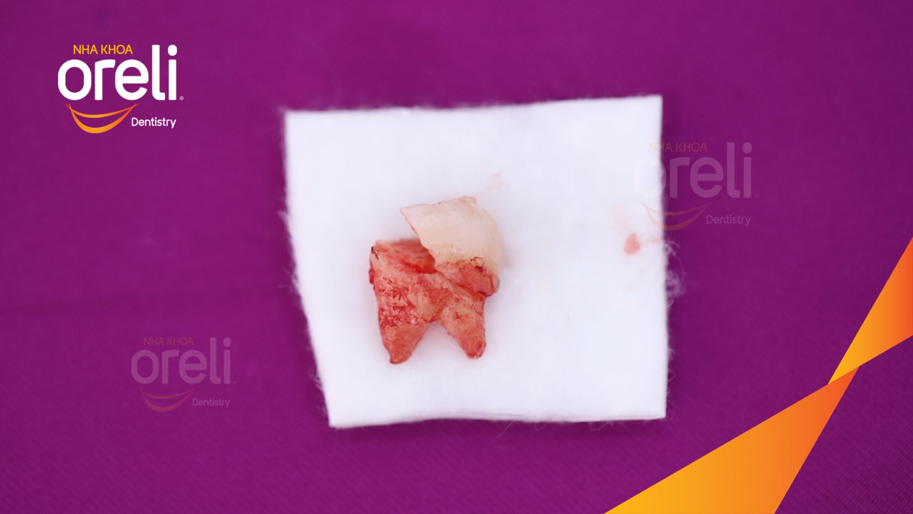 Quá trình Nhổ răng khôn trong 30 phút tại Oreli