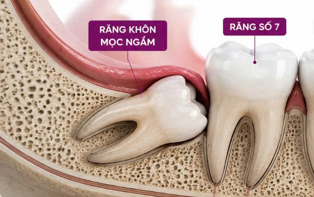 Răng Khôn Mọc Ngầm Có Cần Nhổ Không?
