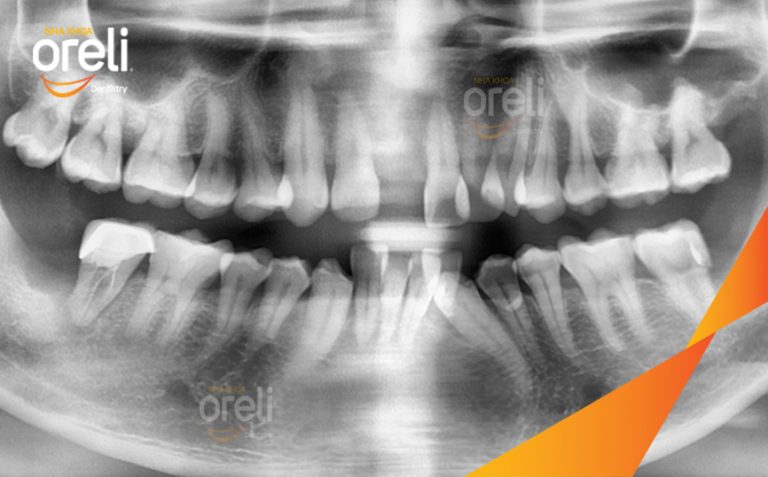 Phục Hồi Răng Mất Hàm Trên  – Case thực tế tại Nha khoa Oreli
