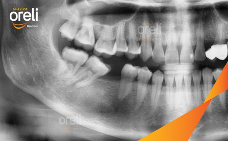 Ca Cấy Trụ Implant Hàm Dưới Tại Nha Khoa Oreli