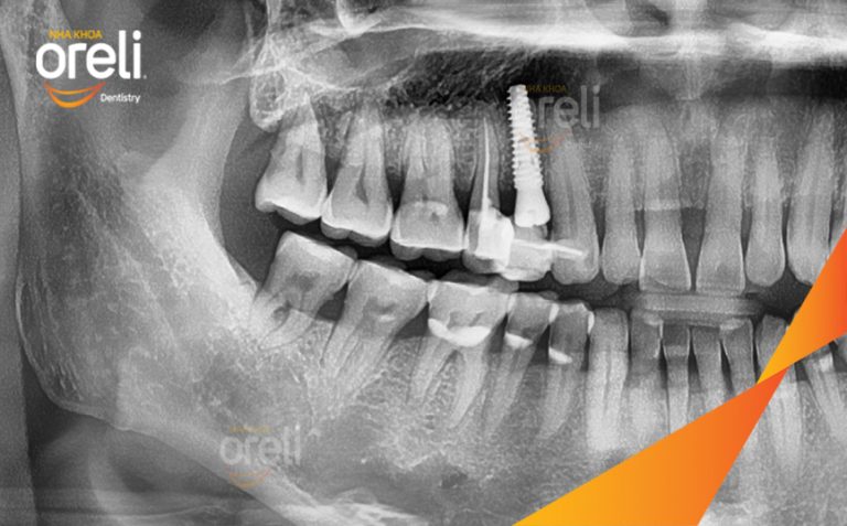 Hoàn Thiện Phục Hồi Răng Mất Hàm Trên Tại Oreli