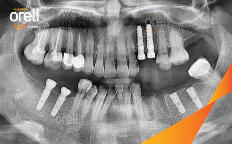Case Cấy Ghép Implant Phục Hồi Nhiều Răng Mất | Nha khoa Oreli