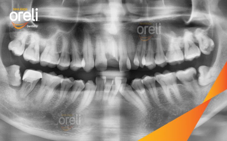 Phục Hồi Răng Mất Hàm Trên  – Case thực tế tại Nha khoa Oreli