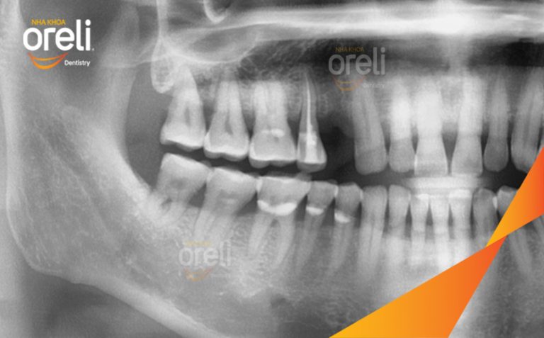 Hoàn Thiện Phục Hồi Răng Mất Hàm Trên Tại Oreli