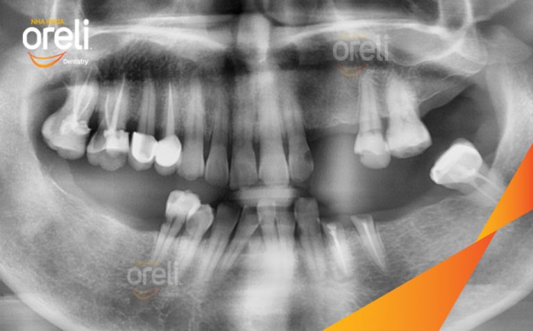 Case Cấy Ghép Implant Phục Hồi Nhiều Răng Mất | Nha khoa Oreli