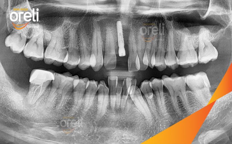 Phục Hồi Răng Mất Hàm Trên  – Case thực tế tại Nha khoa Oreli
