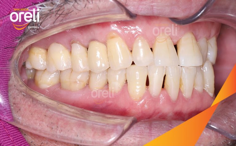 Hoàn Thiện Phục Hồi Răng Mất Hàm Trên Tại Oreli