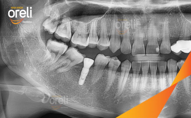Ca Cấy Trụ Implant Hàm Dưới Tại Nha Khoa Oreli