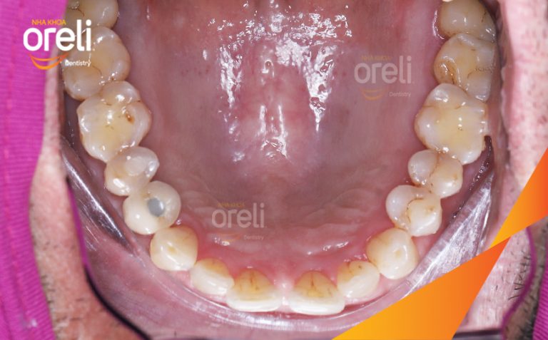 Hoàn Thiện Phục Hồi Răng Mất Hàm Trên Tại Oreli