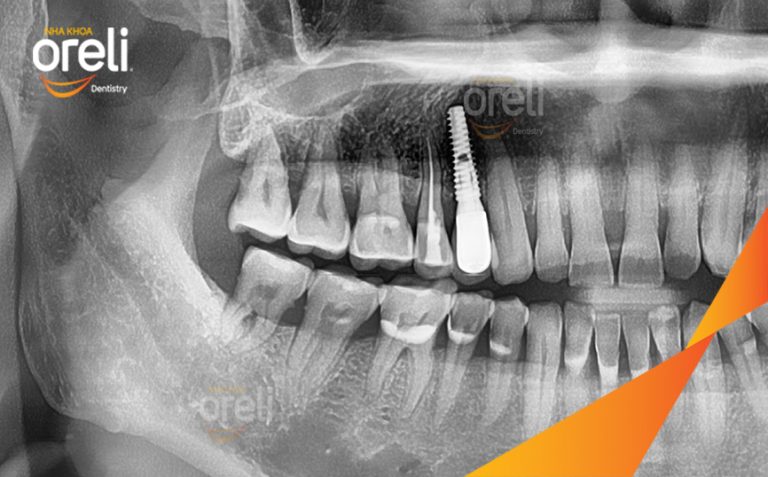 Hoàn Thiện Phục Hồi Răng Mất Hàm Trên Tại Oreli