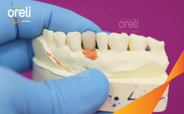 Hoàn Thiện Phục Hồi Răng Mất Hàm Trên Tại Oreli
