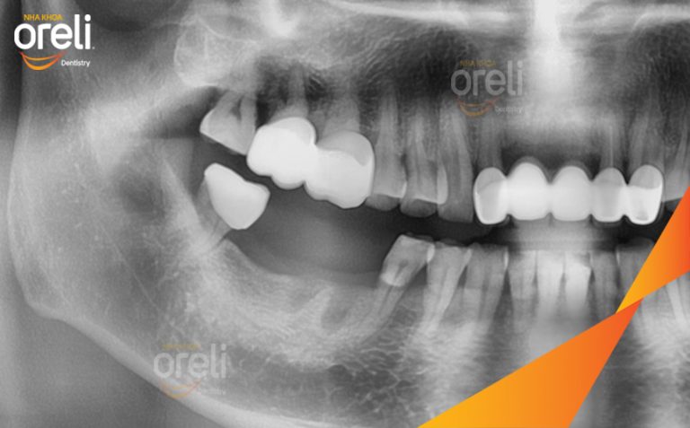 Ca Cấy Implant Phục Hồi Răng Mất Hàm Dưới Tại Nha Khoa Oreli